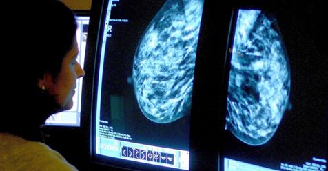 3D Mammography Could Transform Breast Cancer Screening And Save ...